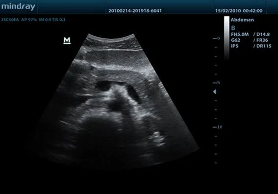 Клинические изображения УЗИ аппарат Mindray DP-50 портативный