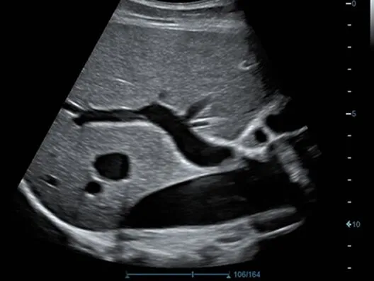 Клинические изображения УЗИ аппарат Mindray DC-70 Exp