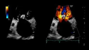Поток регургитации на двойном  экране с ЦДК, M5Sc-D