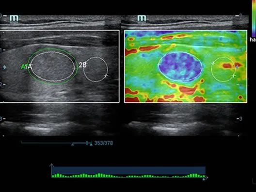 Клинические изображения УЗИ аппарат Mindray DC-70 Exp