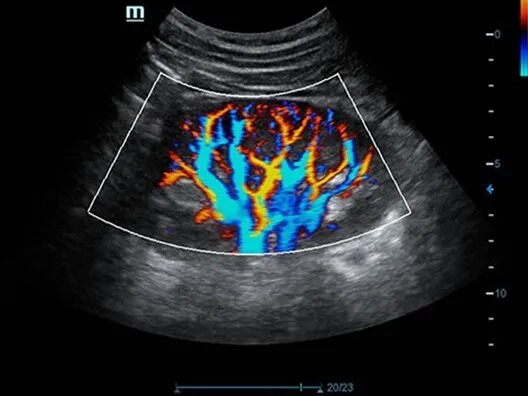 Клинические изображения УЗИ аппарат Mindray DC-70 Exp