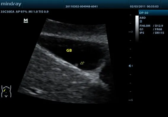 Клинические изображения УЗИ аппарат Mindray DP-50 портативный
