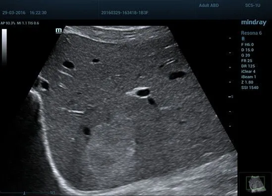 Клинические изображения УЗИ аппарат Mindray Resona 6 Exp