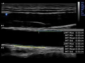 Клинические изображения Siemens Redwood аппарат УЗИ