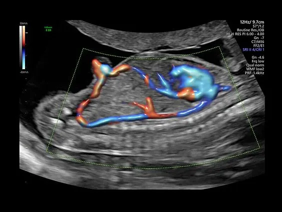 Клинические изображения Ультразвуковая диагностическая система GE Voluson E10