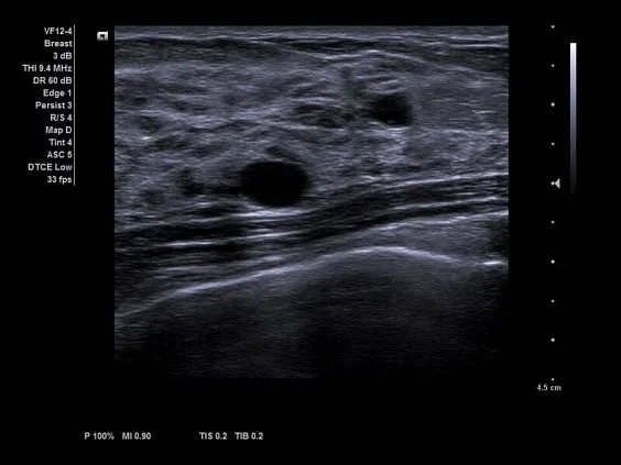 Клинические изображения Ультразвуковая система Siemens Acuson NX3 Elite