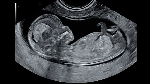 Клинические изображения GE HealthCare Voluson Signature 20 УЗИ аппарат