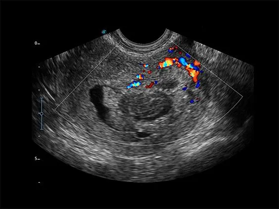 Клинические изображения Sonoscape X3 ультразвуковой аппарат