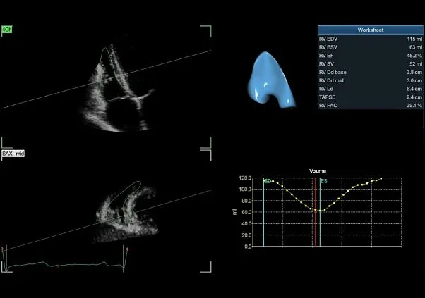 Клинические изображения Ультразвуковая диагностическая система GE HealthCare Vivid E95