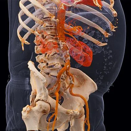 Клинические изображения Siemens SOMATOM go.All компьютерный томограф 