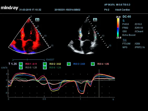 Клинические изображения УЗИ аппарат Mindray DC-60 Pro X-Insight