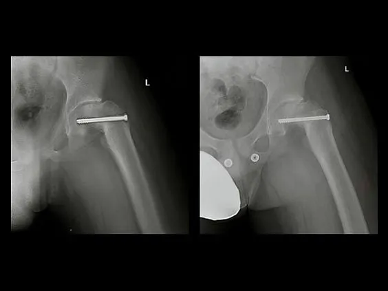 Клинические изображения Цифровой рентгенографический аппарат GE Discovery XR656 HD