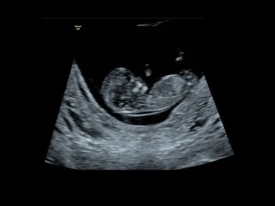 Клинические изображения УЗИ аппарат GE HealthCare Voluson E8 