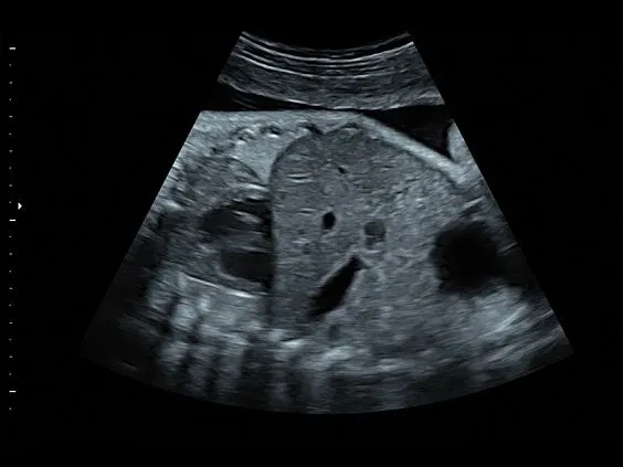 Клинические изображения GE Voluson S8 ультразвуковой аппарат