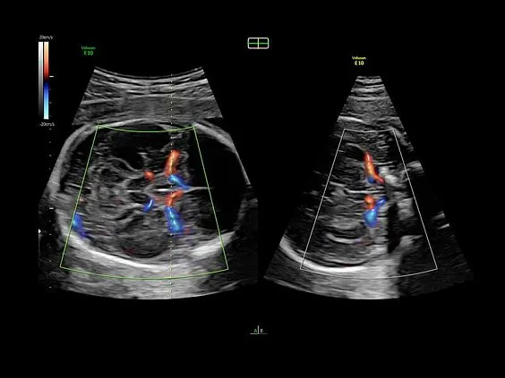 Клинические изображения Ультразвуковая диагностическая система GE Voluson E10