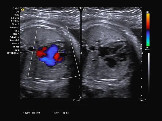 Клинические изображения Ультразвуковая система Siemens Acuson NX3