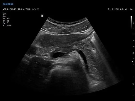 Клинические изображения Samsung Medison V7 УЗИ аппарат