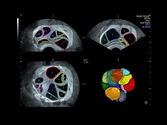 Клинические изображения УЗИ аппарат GE HealthCare Voluson S10