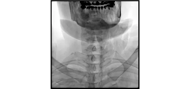 Клинические изображения С-дуга Philips Zenition 30