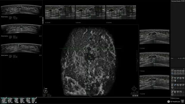 Клинические изображения GE HealthCare Invenia ABUS ультразвуковая система