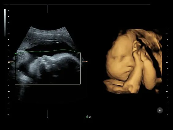 Клинические изображения УЗИ аппарат GE HealthCare Voluson S10