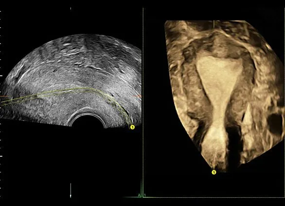 Клинические изображения Ультразвуковая диагностическая система GE HealthCare Voluson E6