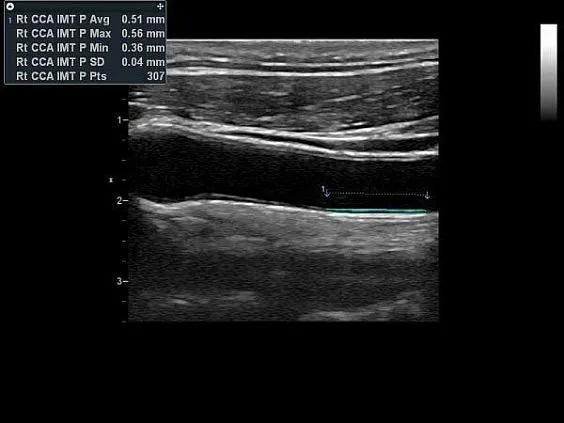 Клинические изображения Ультразвуковая диагностическая система GE HealthCare Vivid T8
