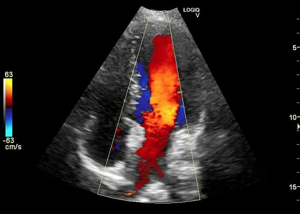 Клинические изображения Ультразвуковая диагностическая система GE Logiq V5