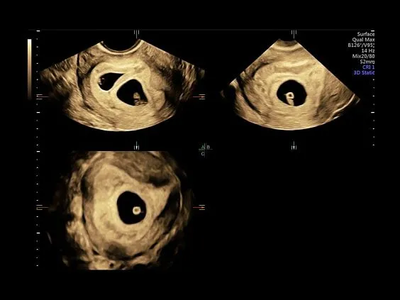 Клинические изображения Ультразвуковая диагностическая система GE Voluson E10