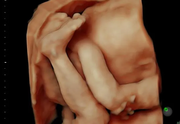 Клинические изображения УЗИ аппарат GE HealthCare Voluson S10