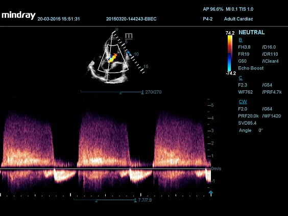 Клинические изображения УЗИ аппарат Mindray DC-60 Pro X-Insight