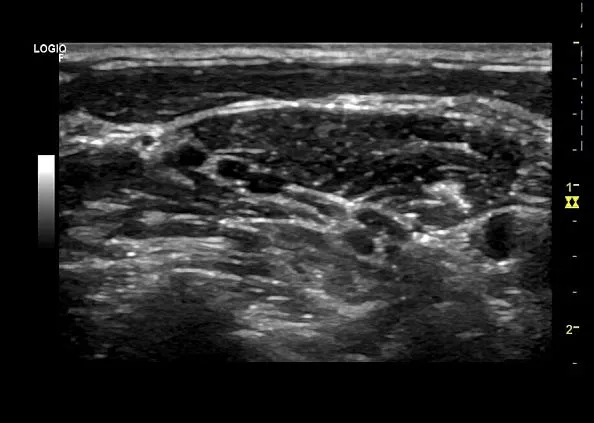 Клинические изображения УЗИ аппарат GE HealthCare Logiq F6