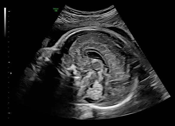 Клинические изображения Ультразвуковая диагностическая система GE HealthCare Voluson E6