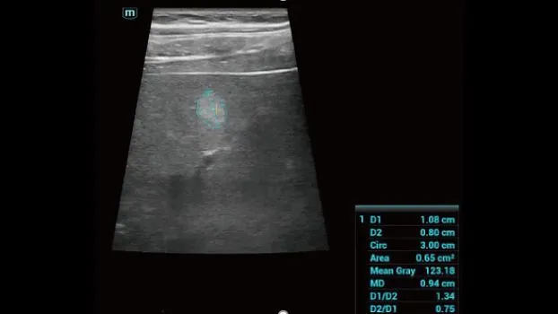 Клинические изображения УЗИ аппарат Mindray Consona N7