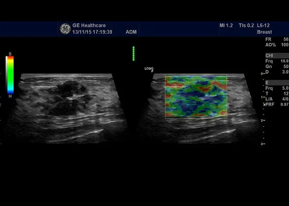 Клинические изображения УЗИ аппарат GE HealthCare Logiq F6