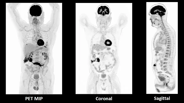 Клинические изображения Siemens Biograph Vision ПЭТ-КТ