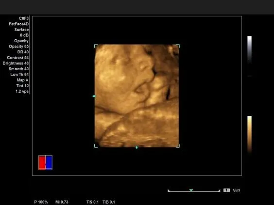 Клинические изображения Siemens Acuson NX2 аппарат УЗИ