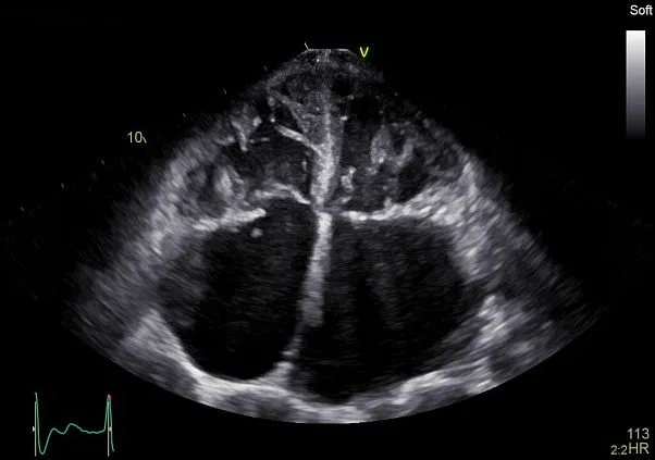 Клинические изображения УЗИ аппарат GE HealthCare Vivid E90