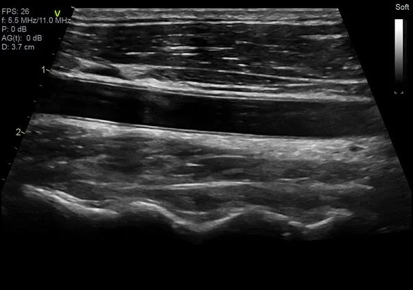 Клинические изображения Ультразвуковая диагностическая система GE HealthCare Vivid E95