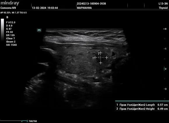 Клинические изображения УЗИ аппарат Mindray Consona N9