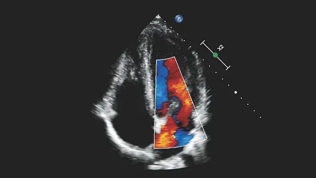 Клинические изображения Philips 5500 ультразвуковой аппарат портативный