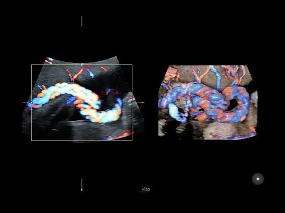 Клинические изображения УЗИ аппарат GE HealthCare Voluson E8 