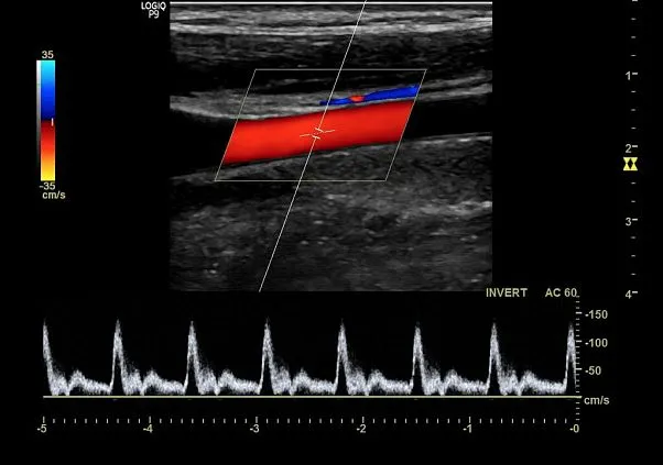 Клинические изображения Logiq P7 УЗИ аппарат GE