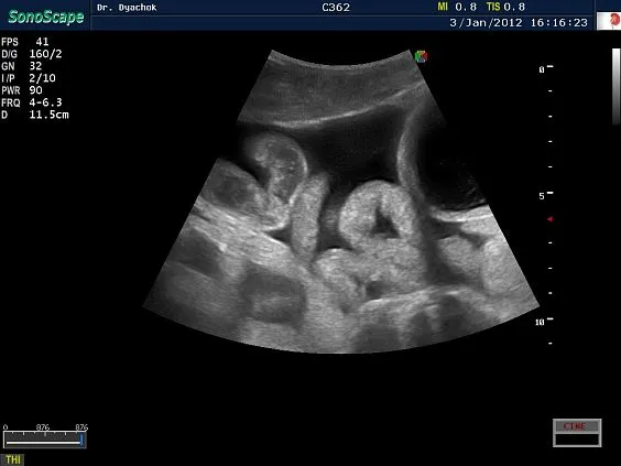 Клинические изображения Sonoscape S9 ультразвуковой аппарат