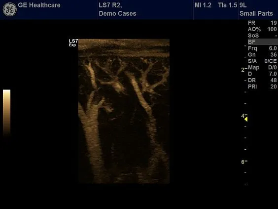Клинические изображения Ультразвуковая диагностическая система GE Logiq S7 XDclear