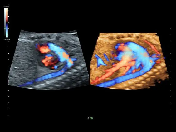 Клинические изображения GE Voluson S6 аппарат УЗИ