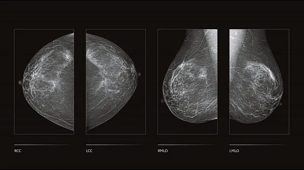 Клинические изображения Цифровой маммограф GE Senographe Crystal Nova