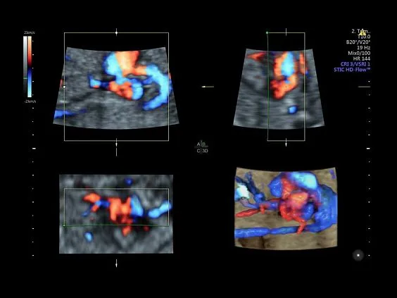 Клинические изображения Ультразвуковая диагностическая система GE Voluson E10