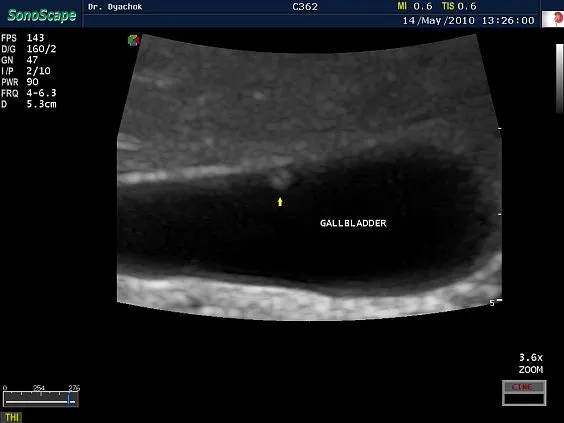 Клинические изображения Sonoscape S9 ультразвуковой аппарат