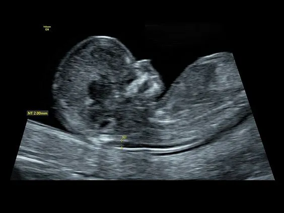 Клинические изображения УЗИ аппарат GE HealthCare Voluson E8 